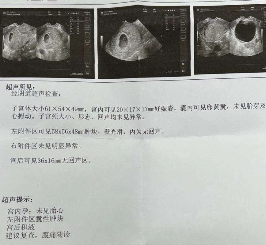 未发现胎心
