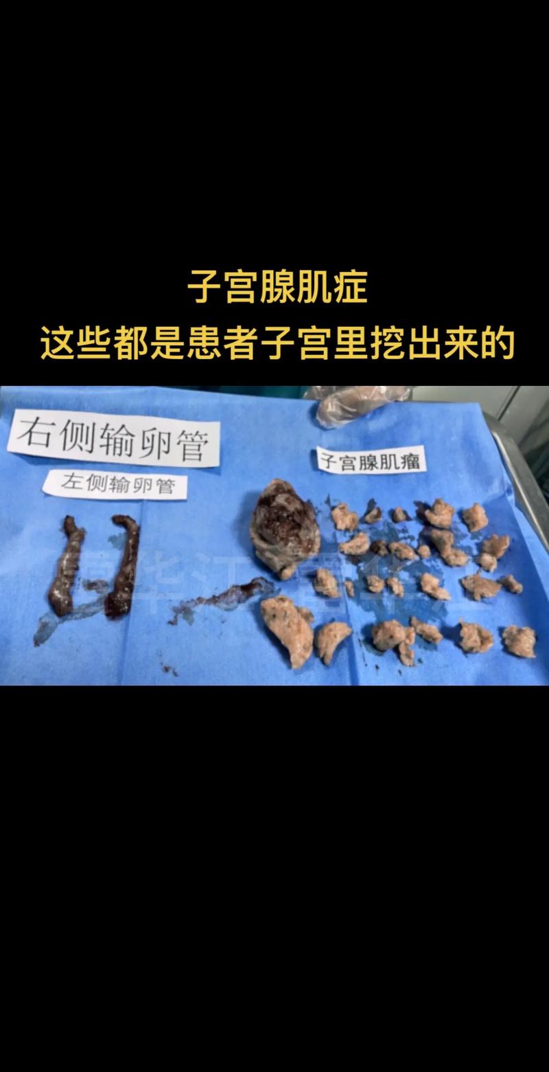子宫肌腺瘤