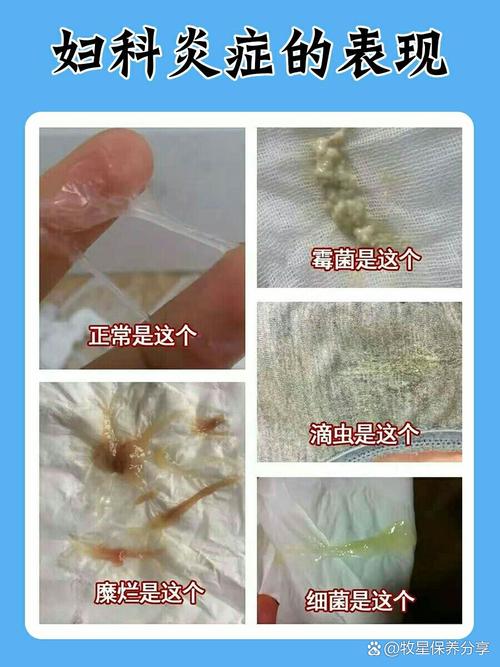 滴虫感染