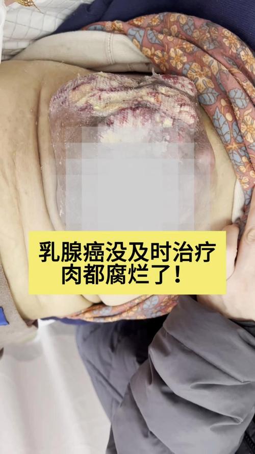  乳腺癌