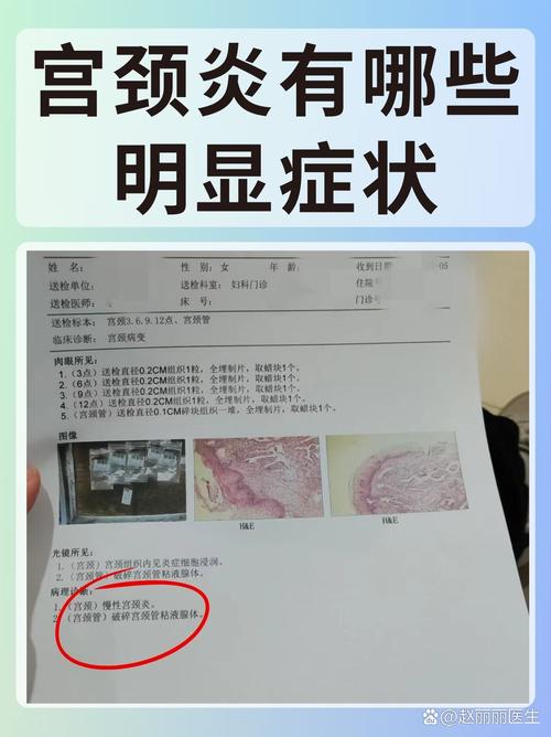  宫颈炎