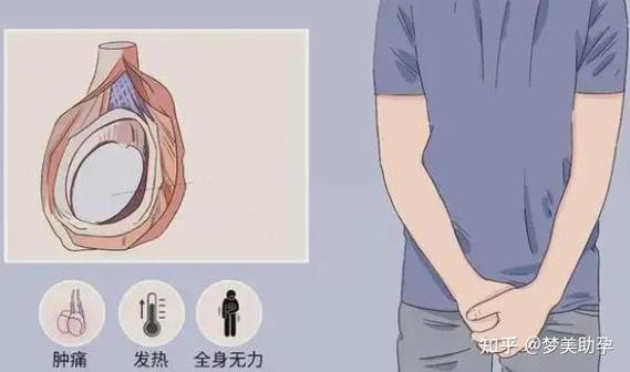 附睾炎患者能否进行试管婴儿助孕？