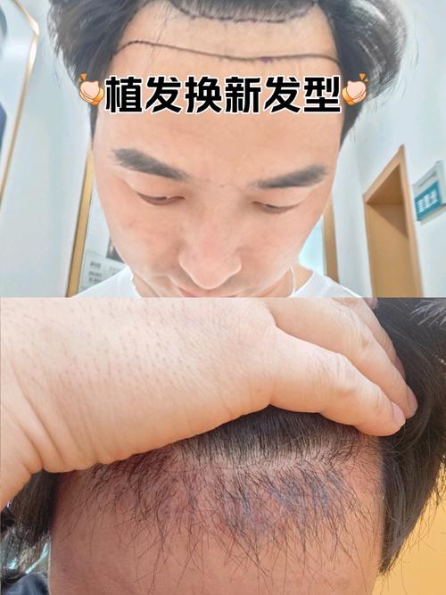 移植52天