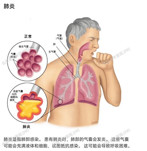 肺炎