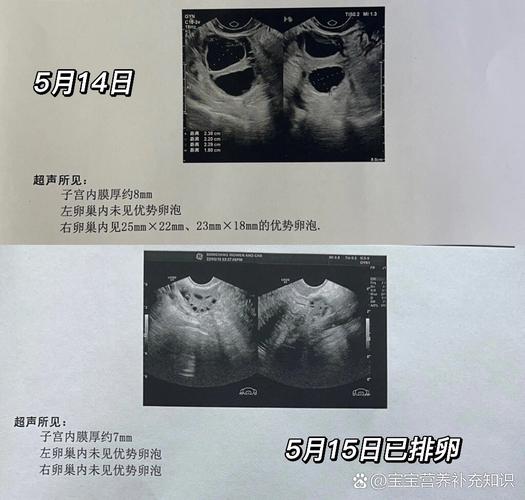 移植两个卵泡