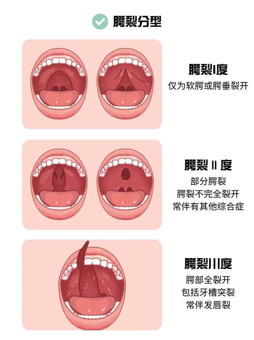 腭裂