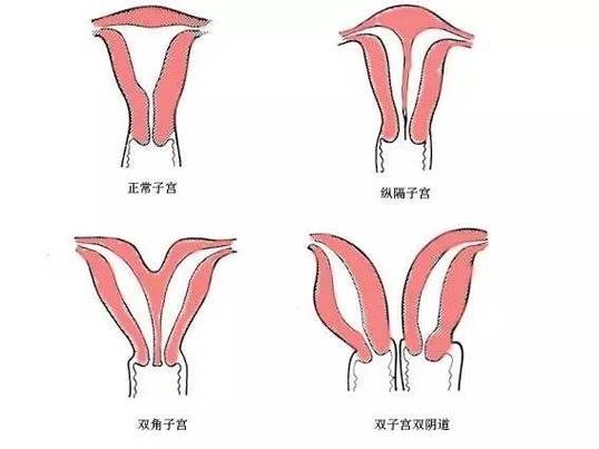 双角子宫患者能否成功进行试管婴儿？