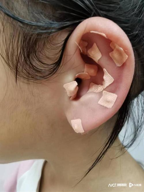  扎耳针