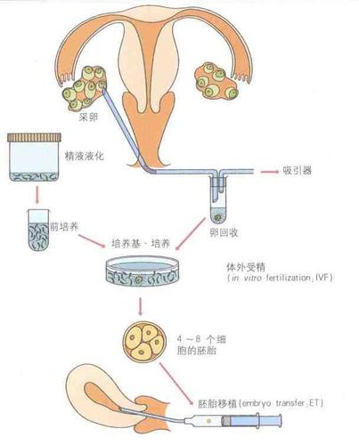纵隔子宫患者能否顺利通过试管婴儿成功受孕？