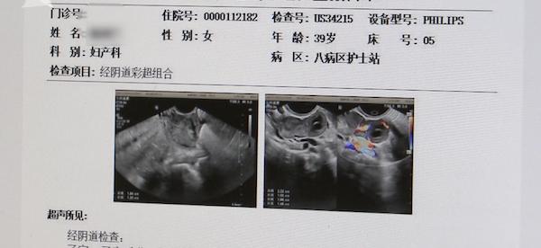  宫内宫外同时怀孕