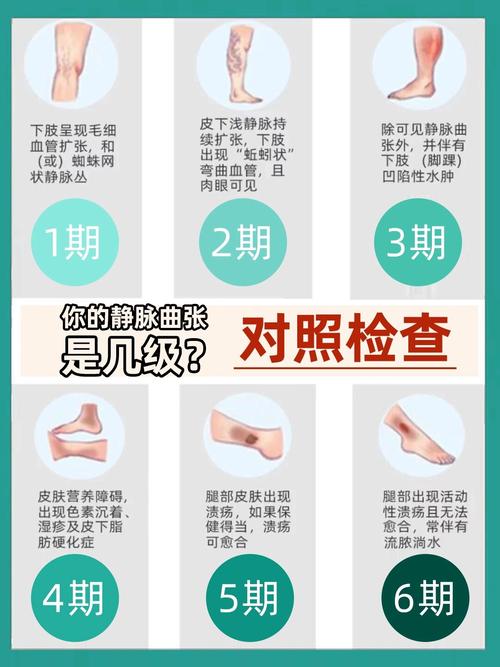 静脉曲张患者能否进行试管婴儿治疗？
