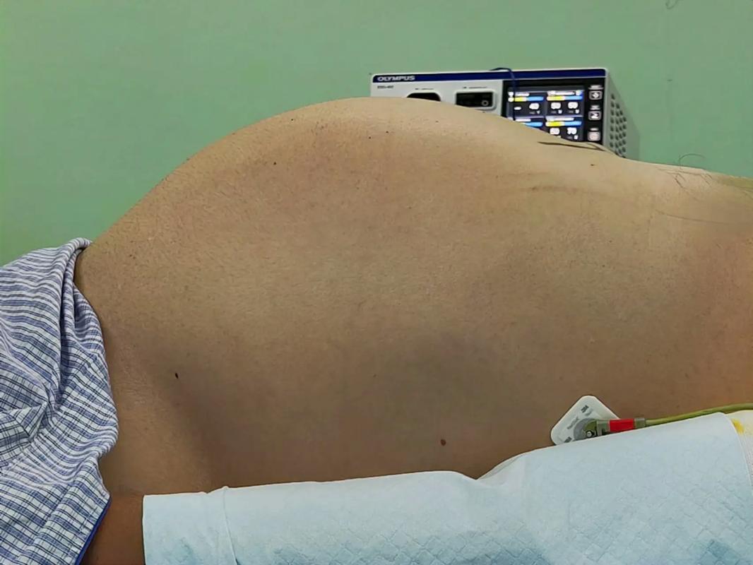  腹部增大