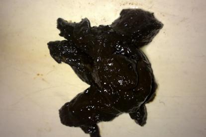 大便发黑