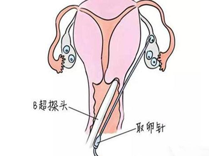 卵泡穿刺术