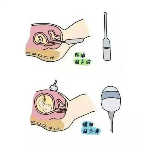 试管婴儿期间能否进行阴道超声检查？