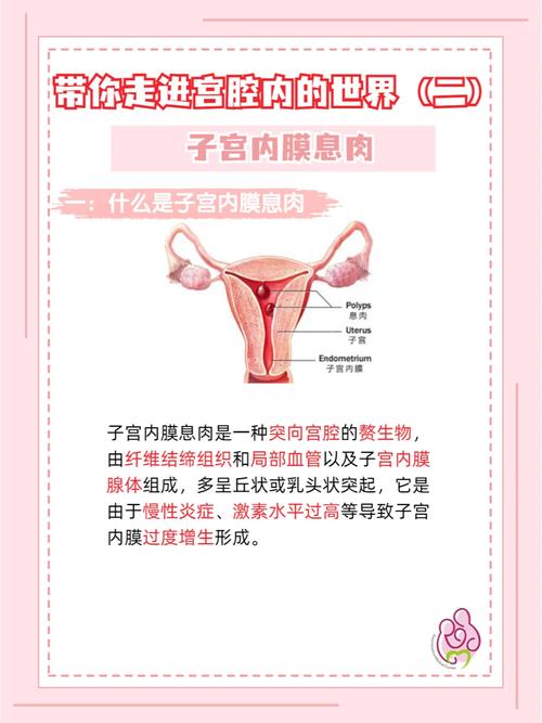 子宫内有息肉的女性是否适合进行试管婴儿治疗？