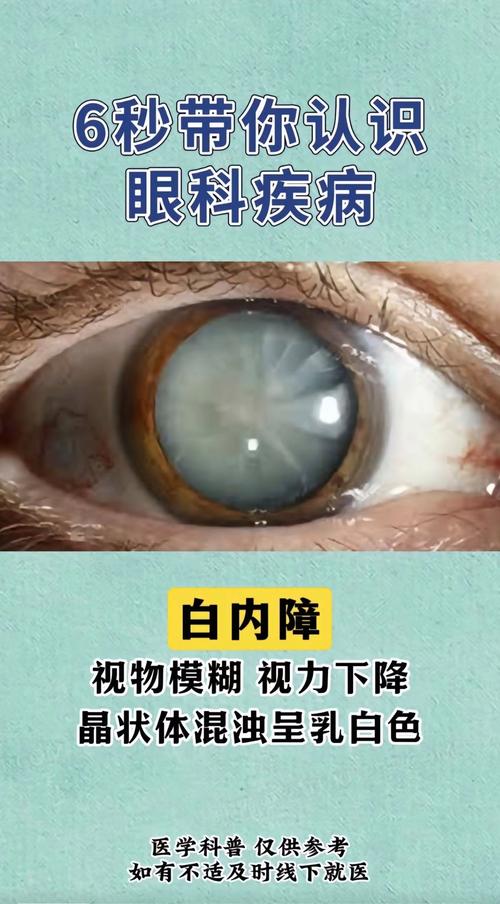 先天白内障