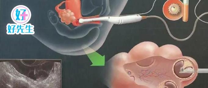 子宫内膜炎患者是否适合进行试管胚胎移植？