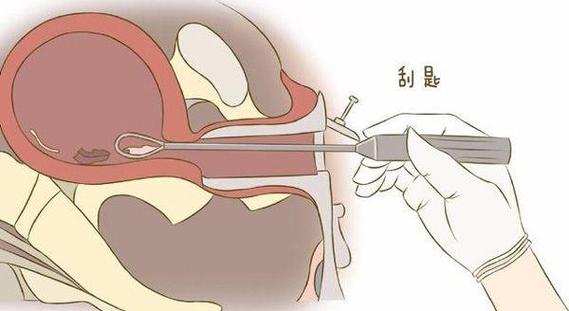 试管婴儿停育后多久需要进行清宫手术？