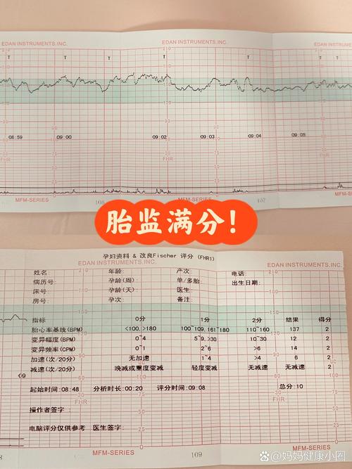 12周胎心监测