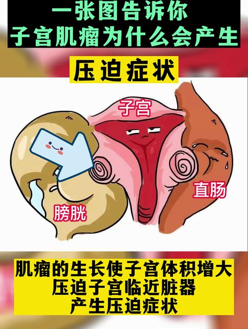 试管婴儿技术是否会增加子宫肌瘤发生的风险？