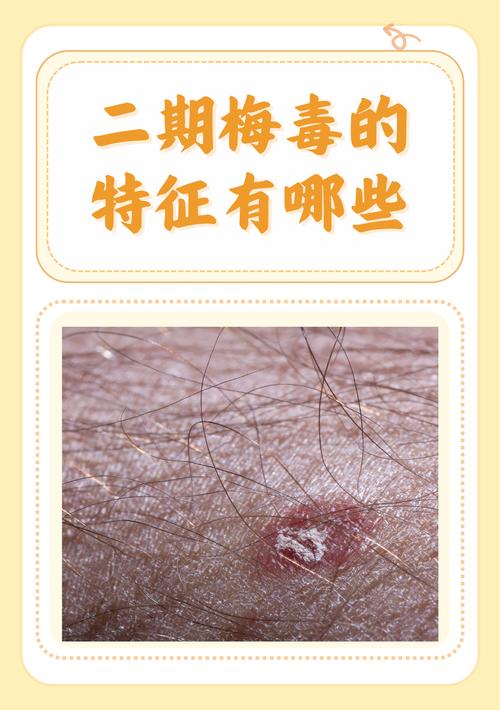 </h2>
<p>梅毒