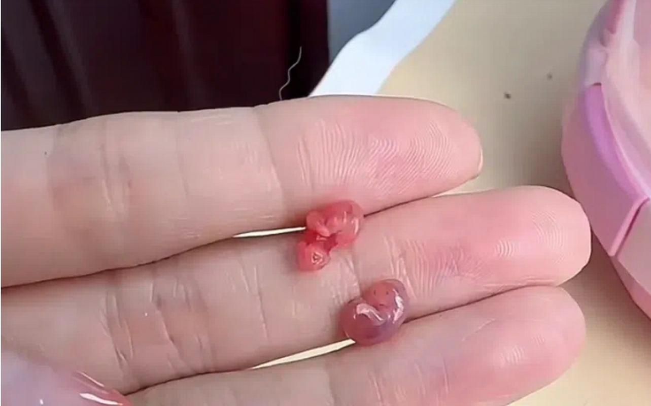  胚胎掉落