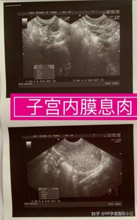 内膜息肉患者是否能成功怀孕？试管婴儿的案例分析