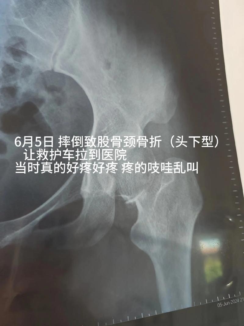 术后38天