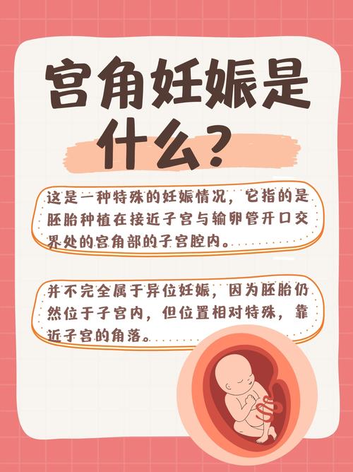 宫角妊娠