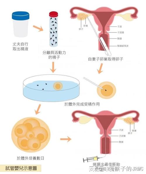 子宫呈Y型是否能够成功进行试管婴儿 IVF？