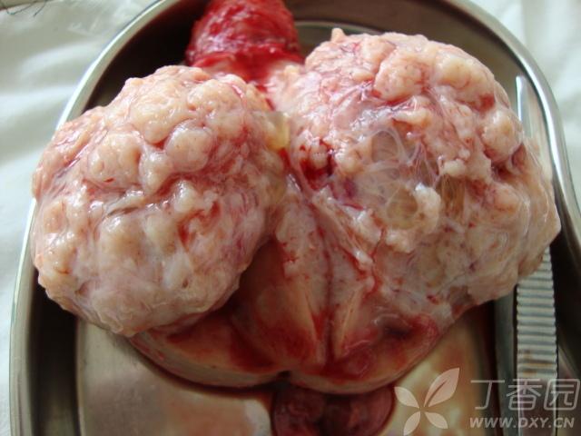 肌瘤变性