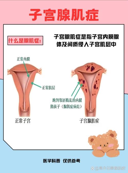 子宫腺肌病