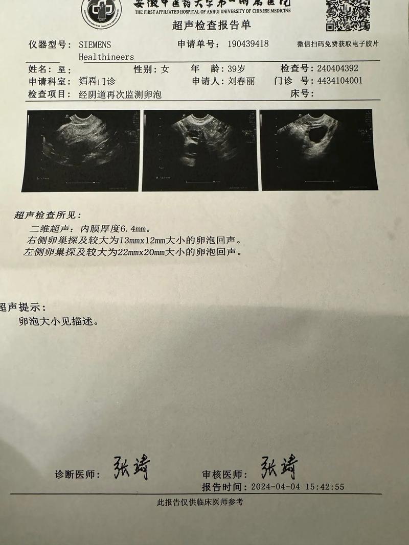  卵泡检查
