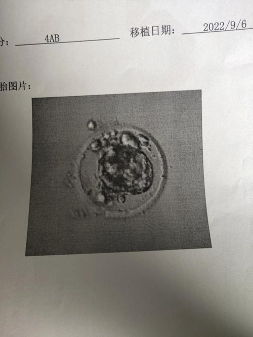 三代移植