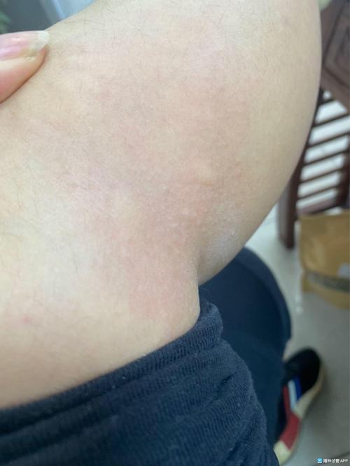 移植后过敏