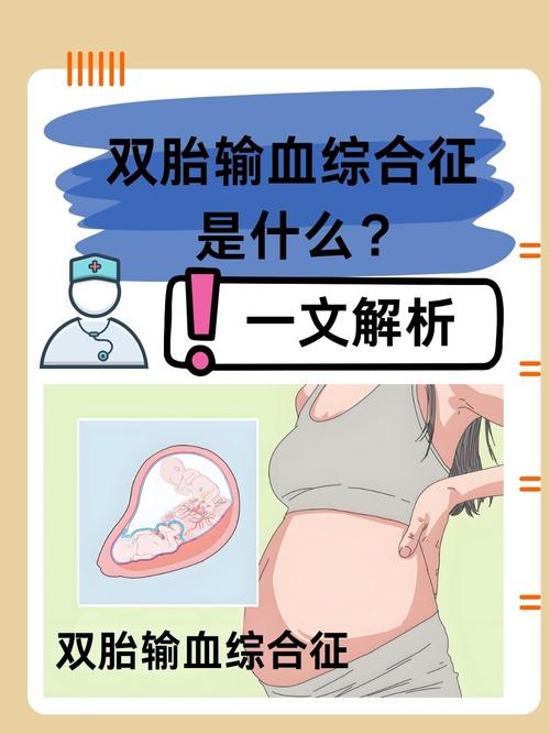 双胎输血综合征