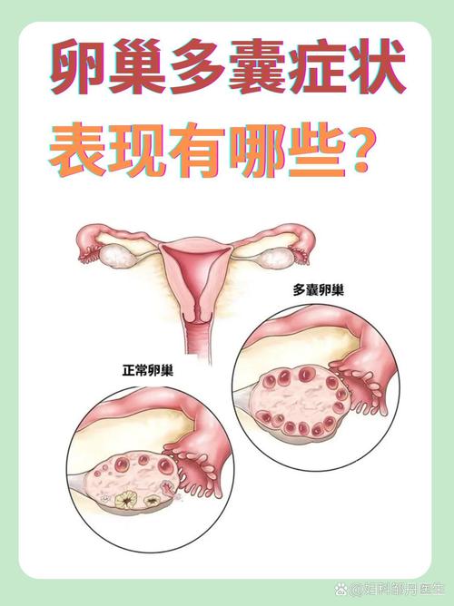 卵巢疾病