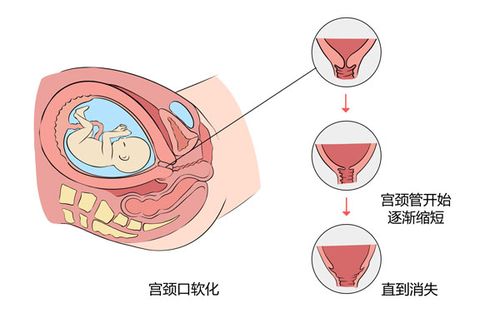 子宫软化