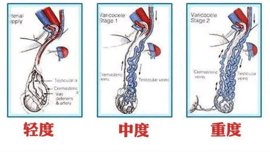 精索静脉曲张患者是否适合进行试管受精治疗？