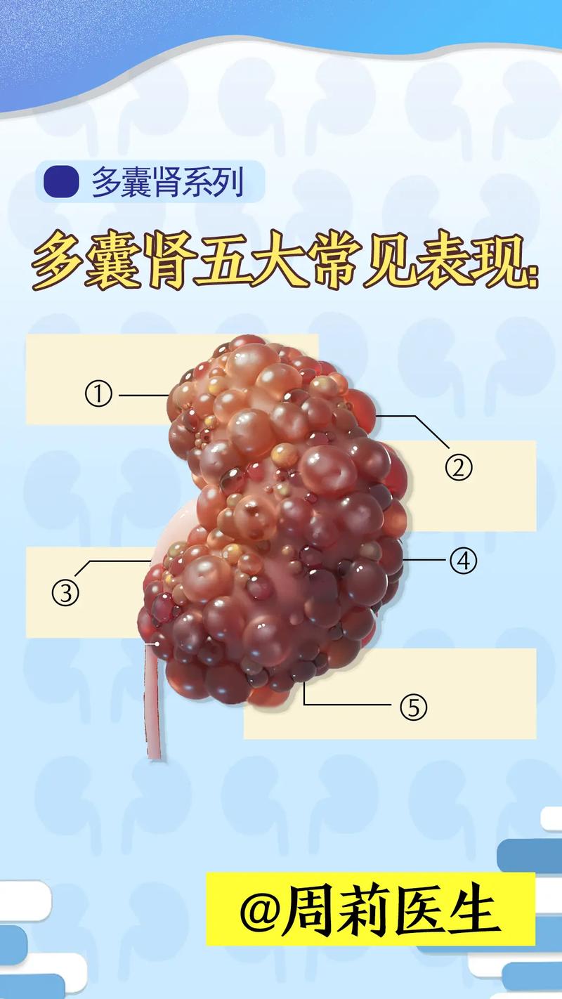  多囊肾