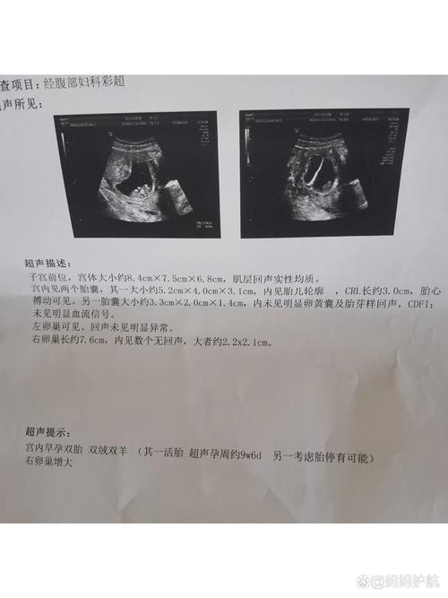 双胞胎停胎