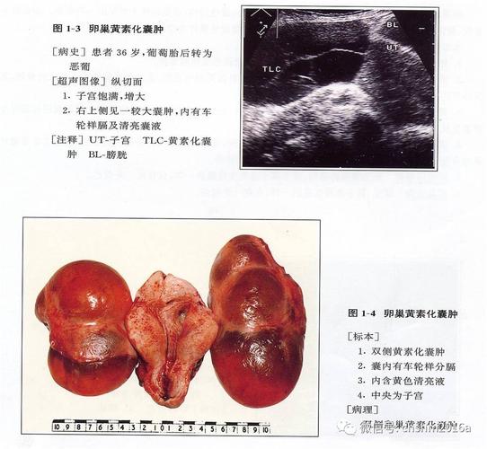 卵巢黄素化囊肿