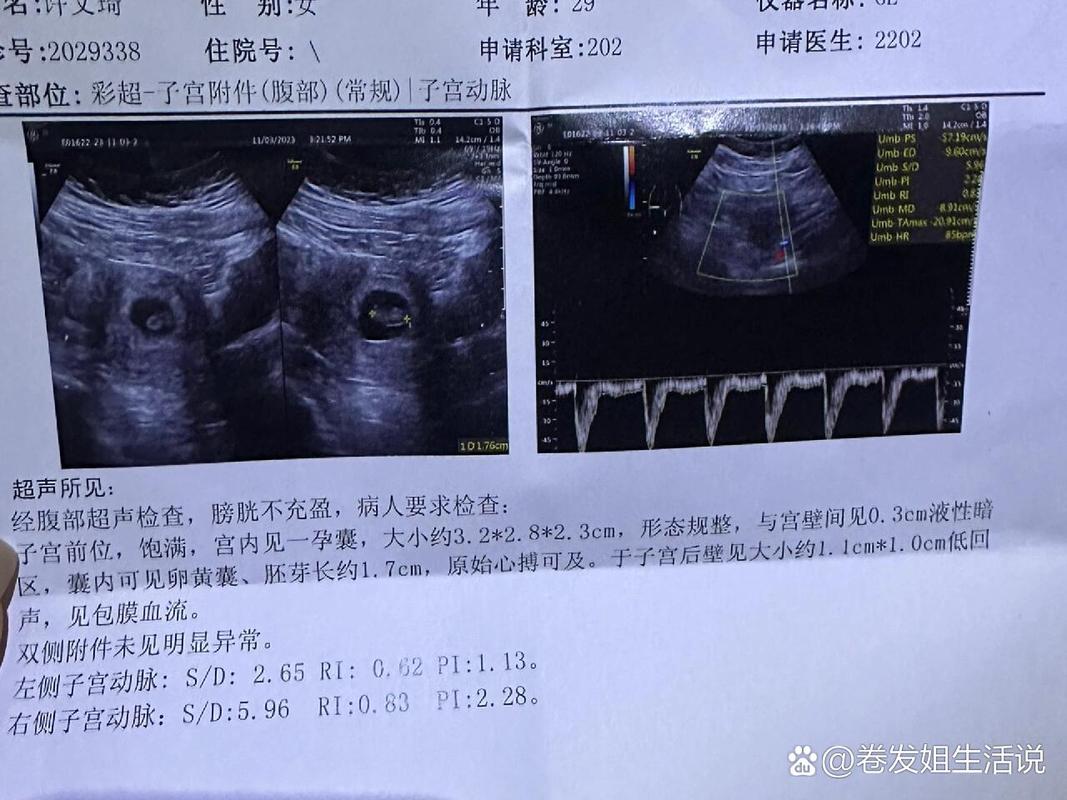 第八周胎心监测