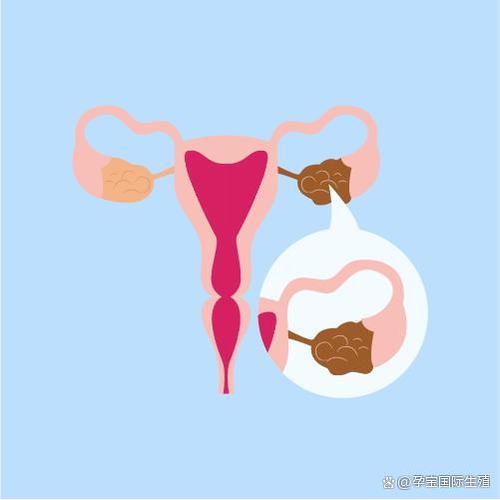 巧克力囊肿患者能否进行试管婴儿治疗？
