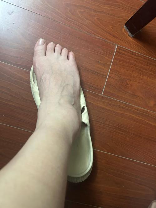 移植后脚肿
