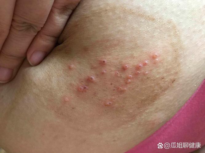 疱疹痊愈后是否适合进行人工试管窈窕孕育？