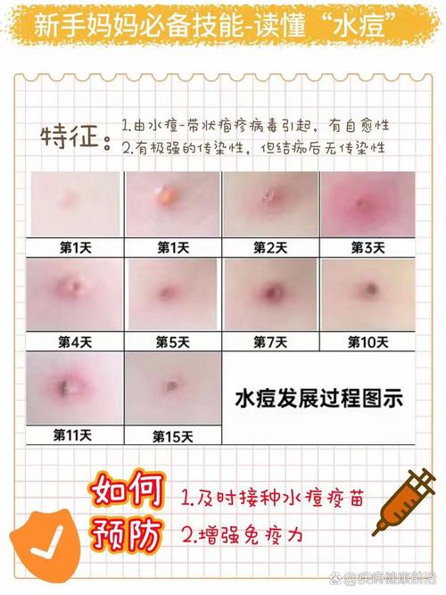 试管移植后为何会出现水痘症状？专业解析