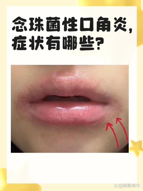 念珠菌