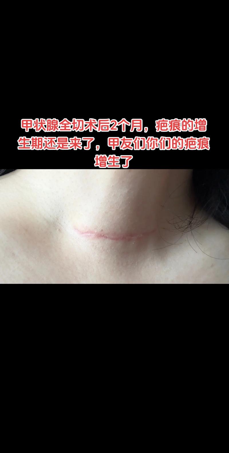 甲状腺全切手术后还能进行试管婴儿吗？